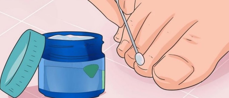 Как избавиться от грибка ногтей